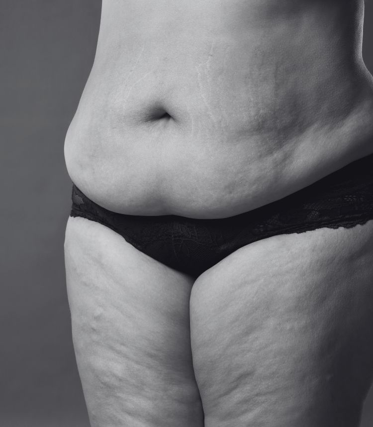 Image comparing mild and severe cellulite grades Sandy