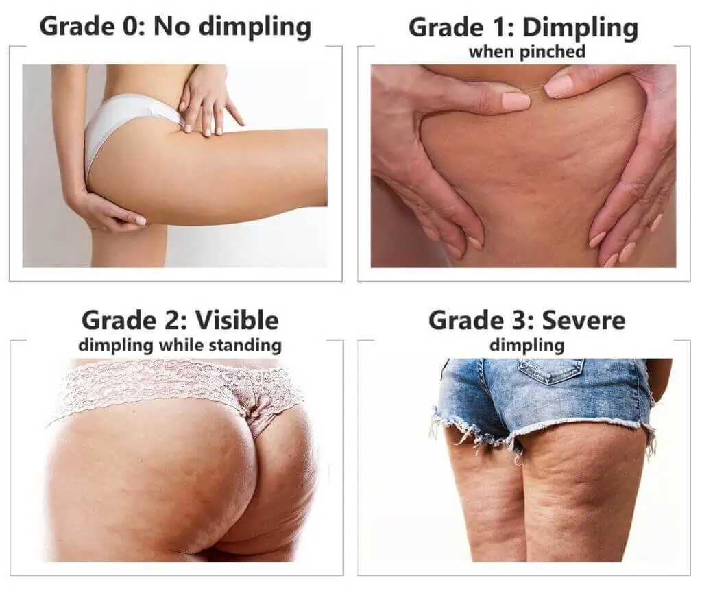 Representation of the stages of cellulite development Sandy